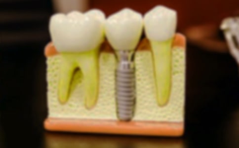 青少年拔牙后注意事项