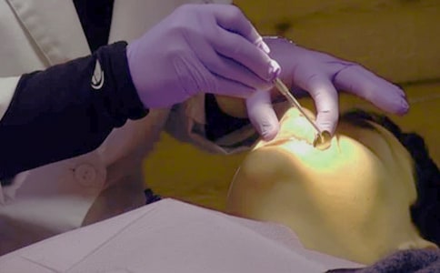 拔完智齿后注意事项有哪些