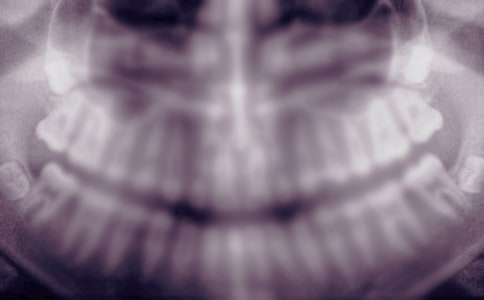 拔智齿后拆线注意事项